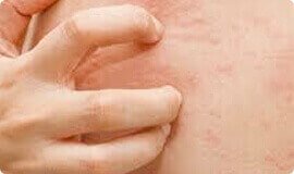 Reações alérgicas - sintoma de parasitas intestinais